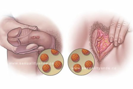 Papilom pe interiorul pleoapei - Papiloamele – cauze, tipuri, metode de tratament - Cancer